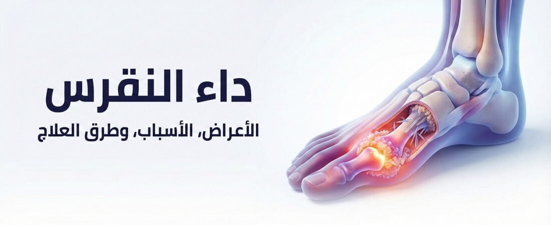 النقرس | Gout