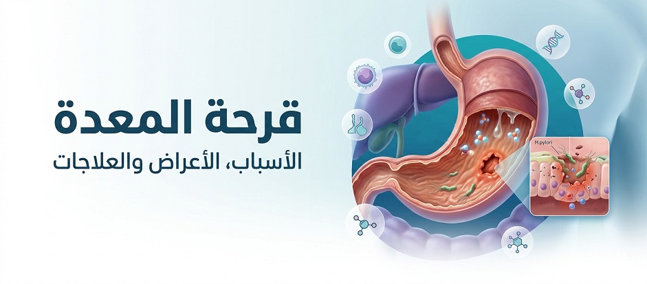 قرحة المعدة | Stomach ulcer