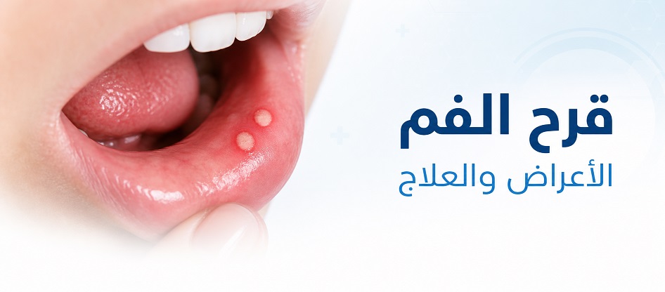 تقرحات الفم | Mouth ulcers