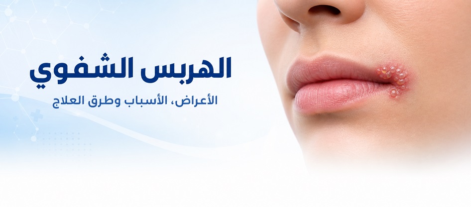القروح الباردة أو الهربس الفموي | Cold sores
