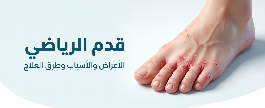 رسم توضيحي لقدم الرياضي: عدوى فطرية بين أصابع القدم مع احمرار وتقشر الجلد